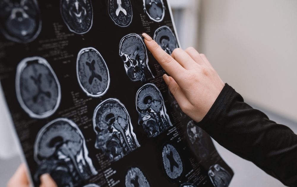 Close-up,Mri,Of,The,Brain,,The,Doctor,Studies,And,Analyzes